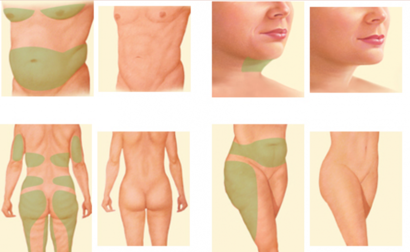 Liposuction Areas