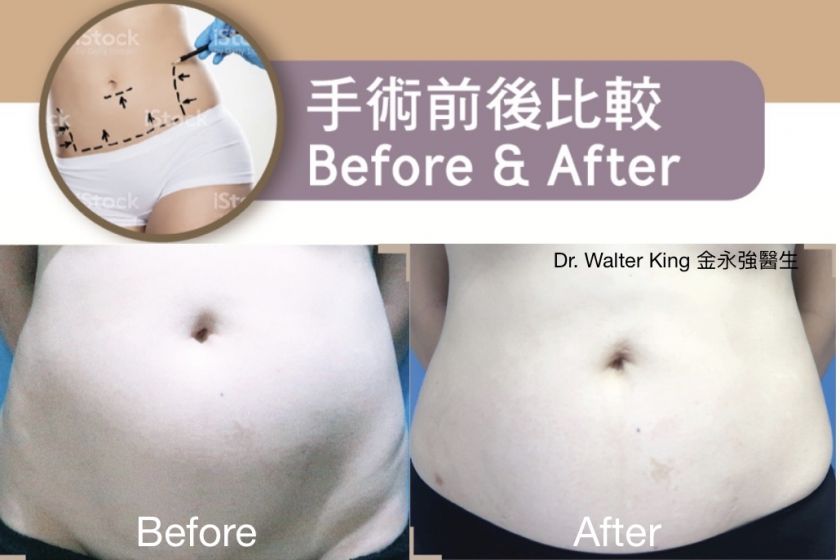 Liposuction Before & After 1