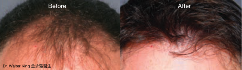 Hair Transplant B&A 1