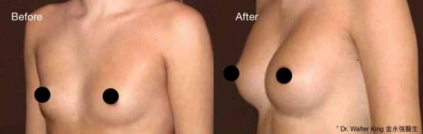 Breast Augmentation B&A