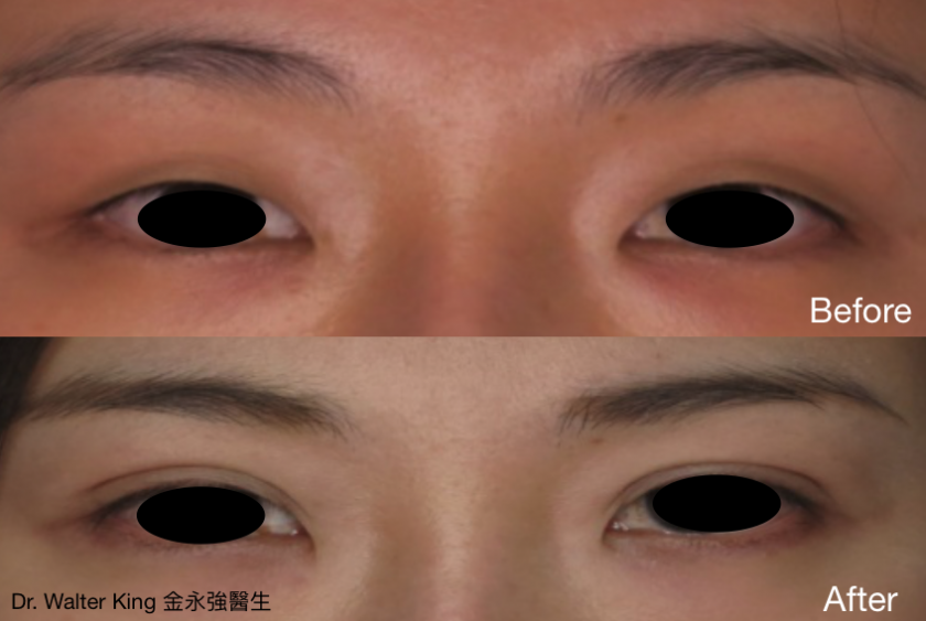 Double eyelid surgery B&A 4