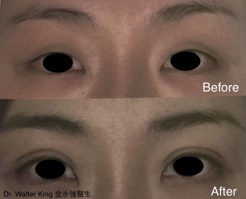 Double Eyelid Surgery Before & After