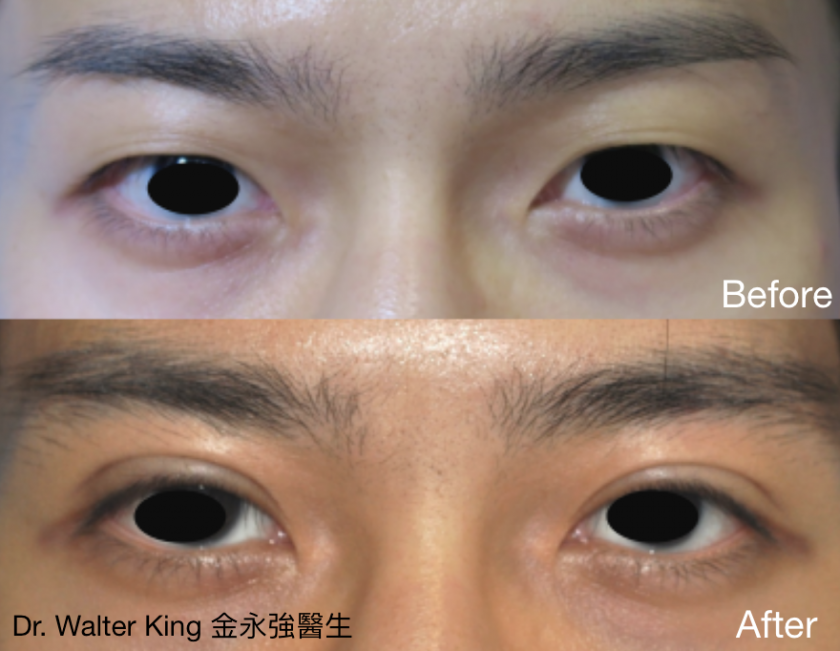 Double Eyelid Surgery Before & After 3