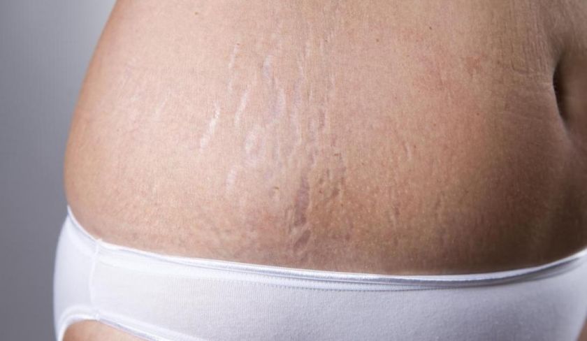 Stretch Marks